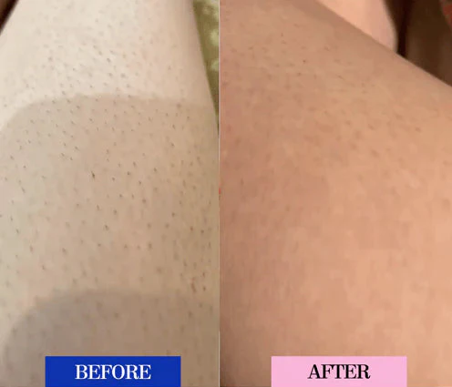 Before and after Thighs results using the HeySilkySkin IPL Laser Hair Removal Handset