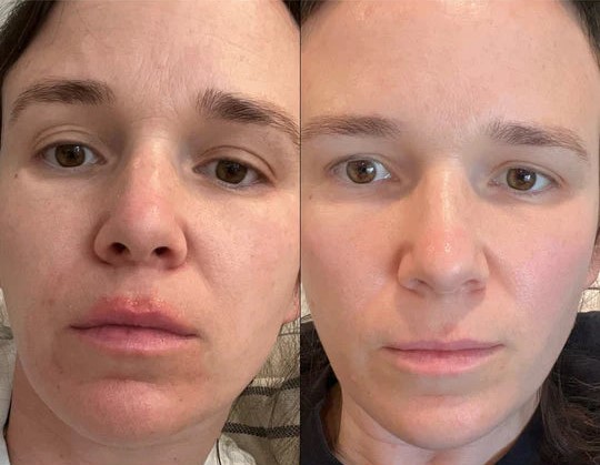 Before and after Facial skin results using the HeySilkySkin Red Light Therapy Wand