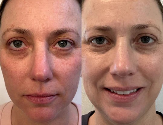 Before and after Facial skin results using the HeySilkySkin Red Light Therapy Wand