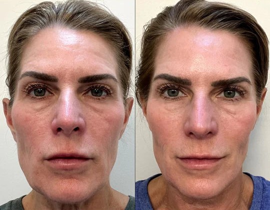 Before and after Facial skin results using the HeySilkySkin Red Light Therapy Wand