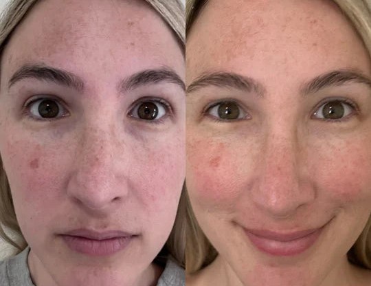 Before and after Facial skin results using the HeySilkySkin Red Light Therapy Wand